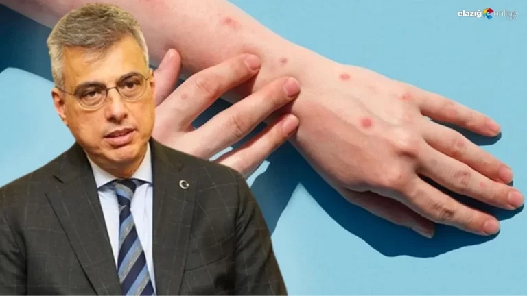 Bakan’dan ‘maymun çiçeği’ açıklaması: Alarmdayız