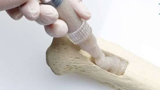 Çinli Bilim İnsanlarından Devrim: 3 Dakikada Kemiği Yapıştıran Buluş